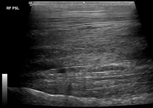 Ultrasound-4-Scarlette